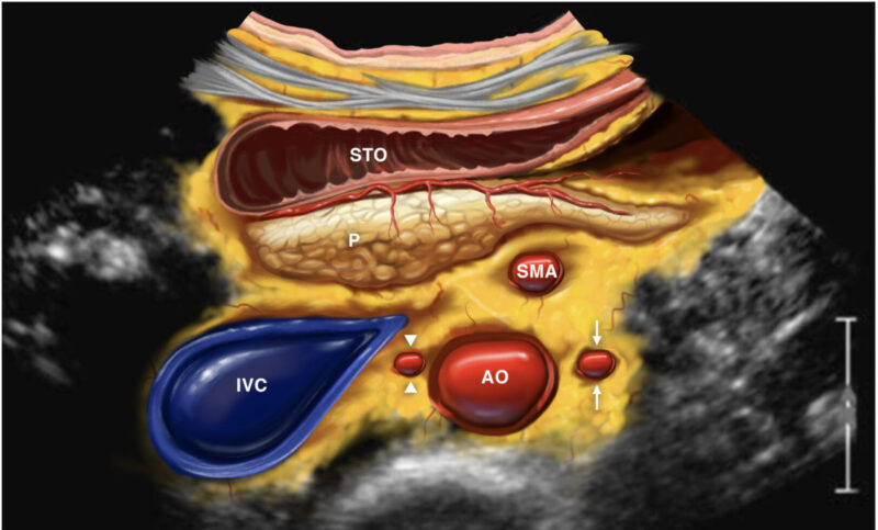 Yüksel Ürün: Celiac plexus radiosurgery offers promising pain relief for advanced cancer