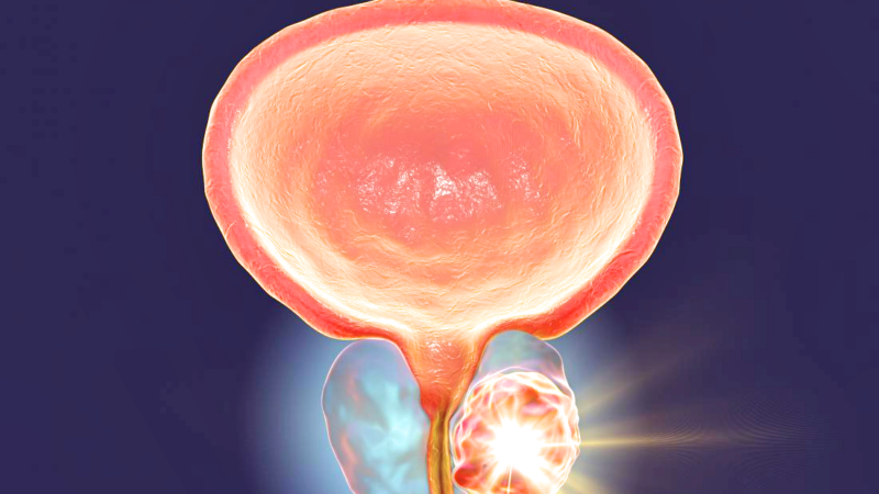 Notch signaling in advanced prostate cancer