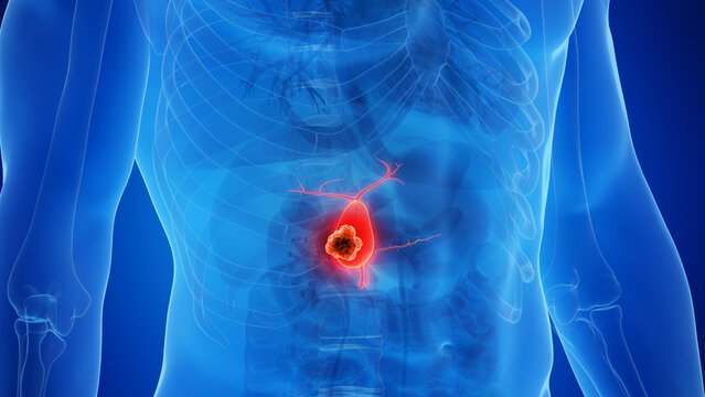 Novel cancer genes in biliary tract cancers in PSC