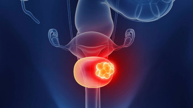 Pfizer’s Sasanlimab with BCG Improved Event-Free Survival in High-Risk Bladder Cancer