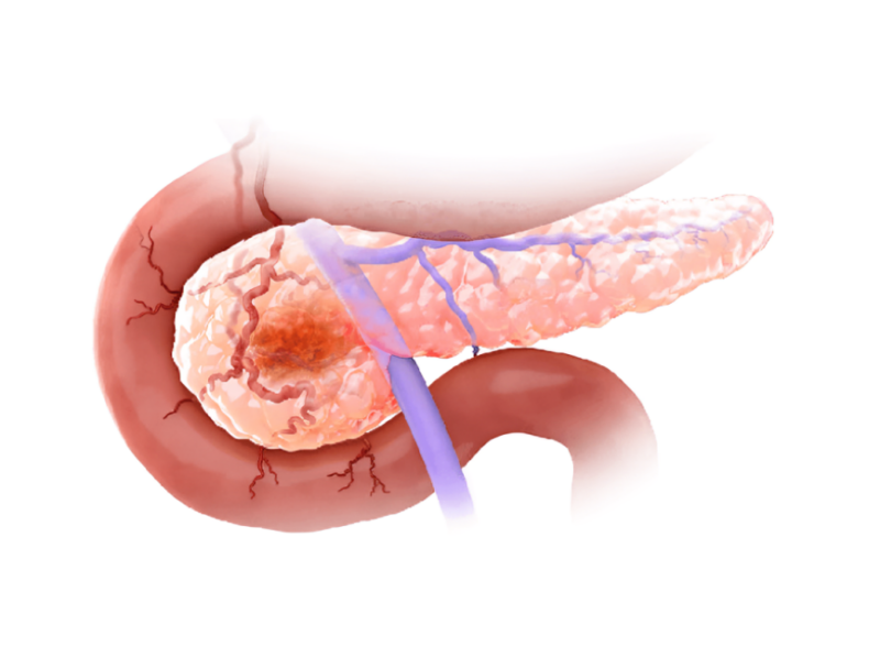 ctDNA variant-specific differences as potential mPDAC prognostic biomarker – PICI