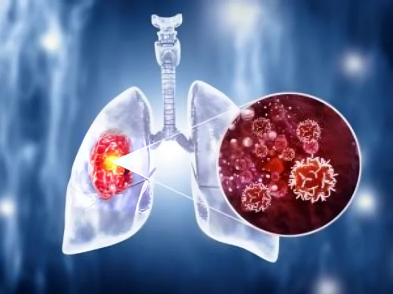 Stephen V Liu: Rapid communication on management of stage III NSCLC by ASCO