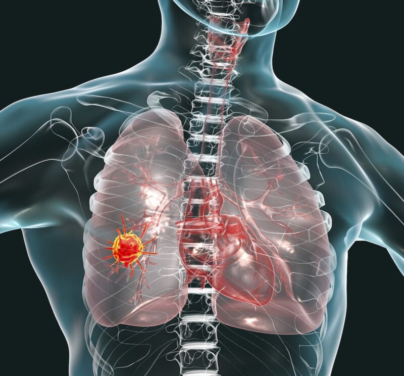 Cancer treatments can activate dormant tumor cells in the lung triggering metastasis