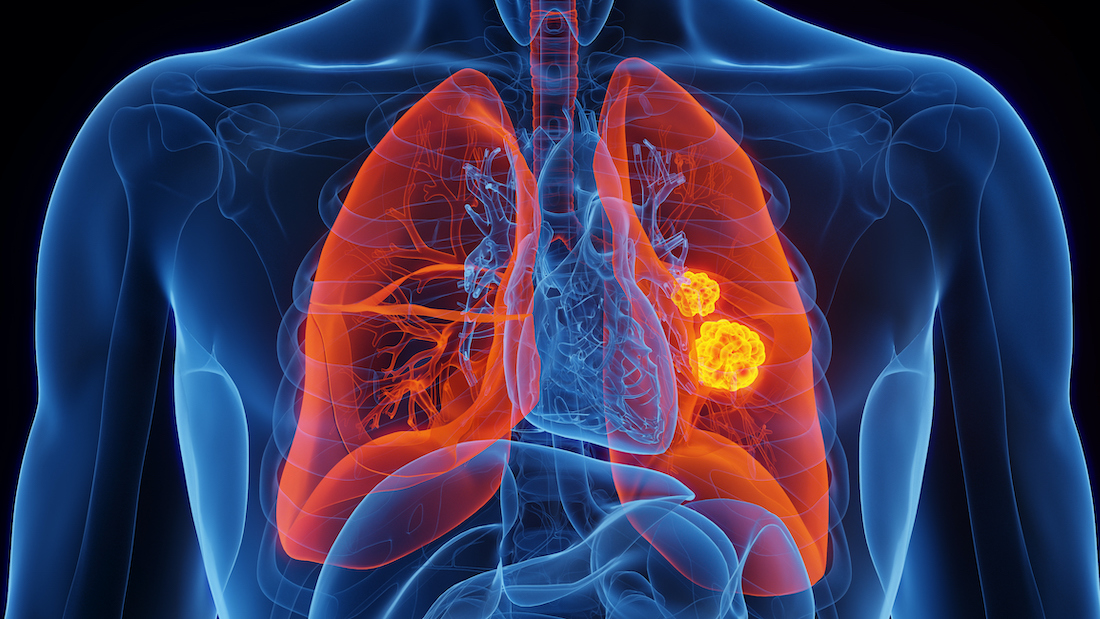 Clinical Validation of a Cell-free DNA assay for Early Lung Cancer Detection