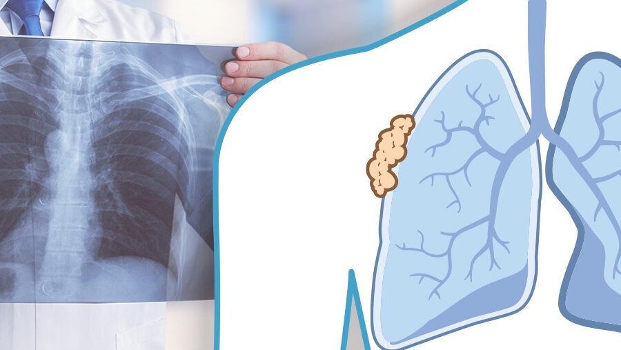 Bevacizumab and carboplatin-pemetrexed chemotherapy with/out atezolizumab for advanced pleural mesothelioma