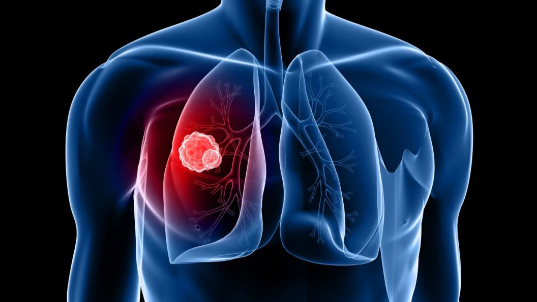 Evaluating Pregabalin for Chronic Cough in Lung Cancer