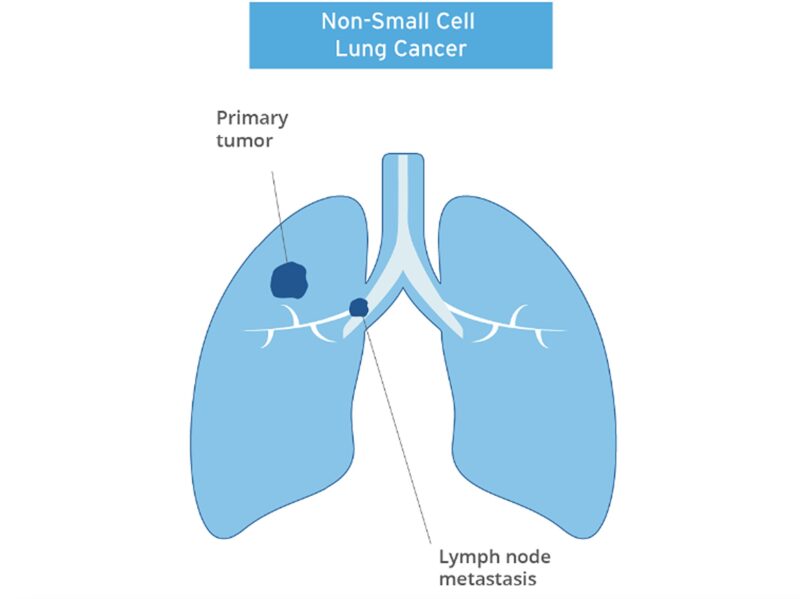 Raffaele Colombo: Trastuzumab rezetecan in patients with HER2-mutant NSCLC