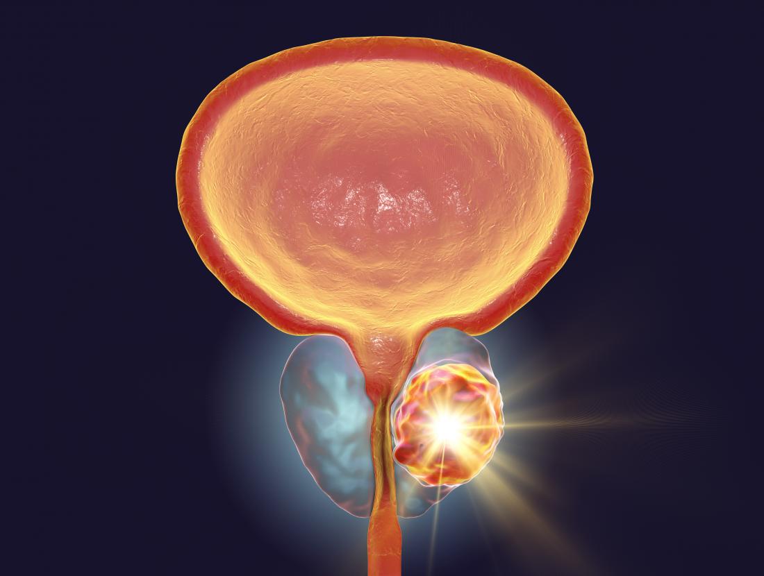 Meta-analysis of 20 RCTs with 14,995 Metastatic Castrate-sensitive Prostate Cancer patients