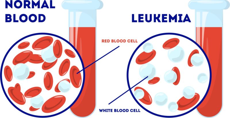 Shahrin Ahmed: Pregnancy complications are more likely for young cervical cancer and leukemia survivors