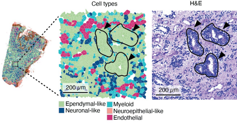 Daeun Jeong: Cell-intrinsic and extrinsic factors underlying malignancy in supratentorial ependymomas