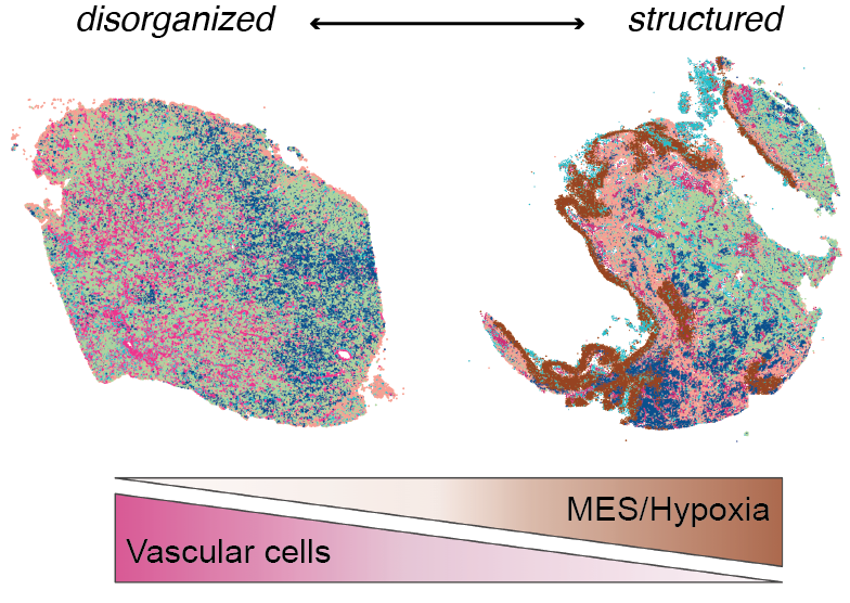 Daeun Jeong: Cell-intrinsic and extrinsic factors underlying malignancy in supratentorial ependymomas