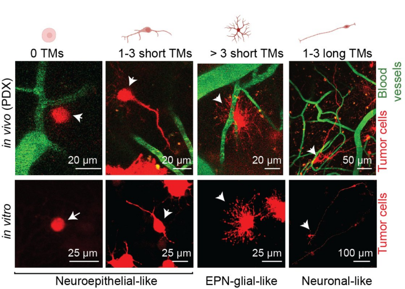 Daeun Jeong: Cell-intrinsic and extrinsic factors underlying malignancy in supratentorial ependymomas