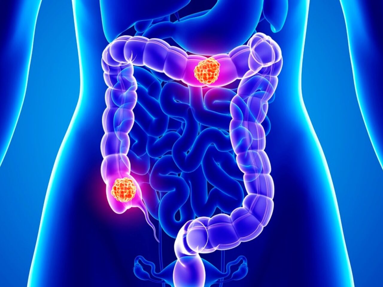 The genomic landscape of 2023 colorectal cancers