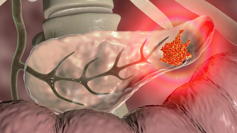 Enhancing post – operative treatment for pancreatic ductal adenocarcinoma through AI