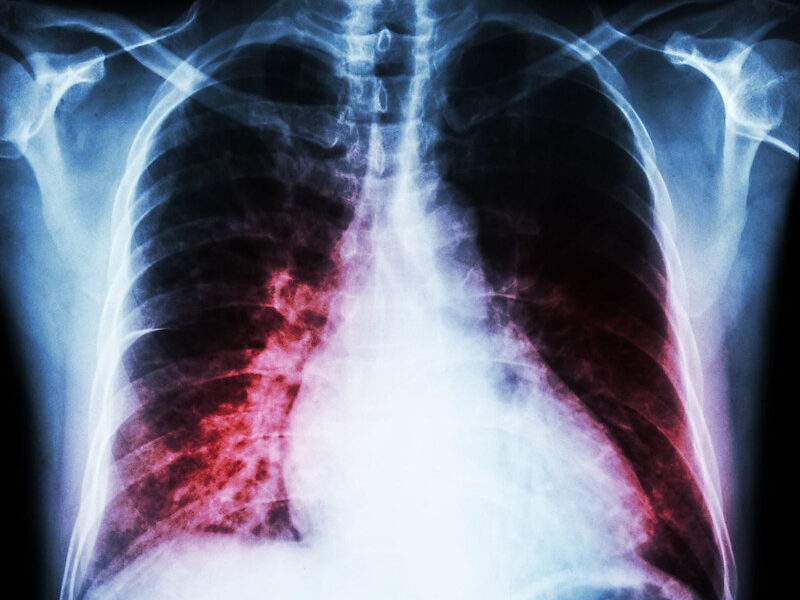 Metastatic lung adenocarcinoma with EGFR and TP53 co-mutations shows mixed intra-patient tumor responses