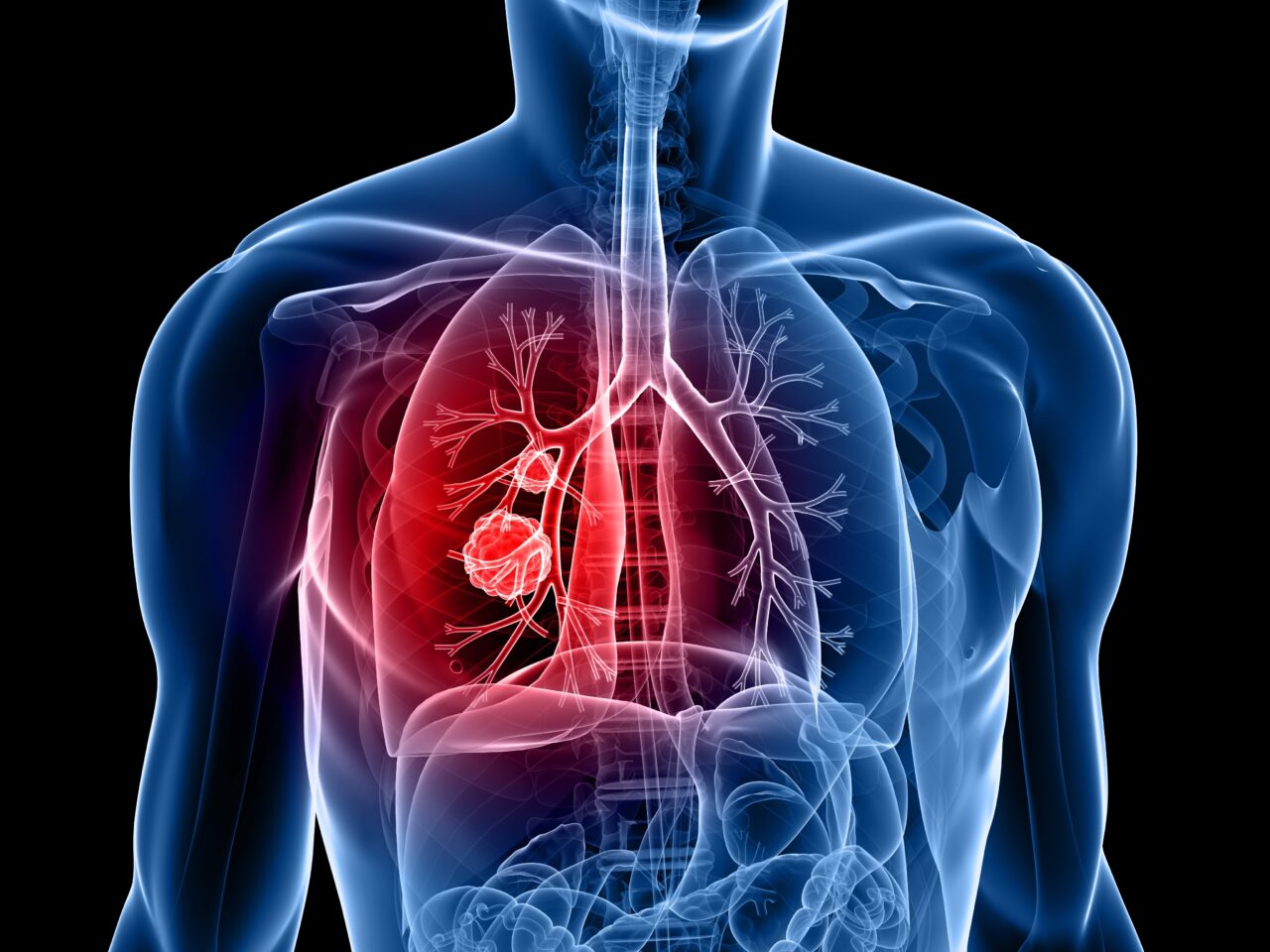 ES-SCLC 5-year survival outcomes inIMpower133 and IMbrella study