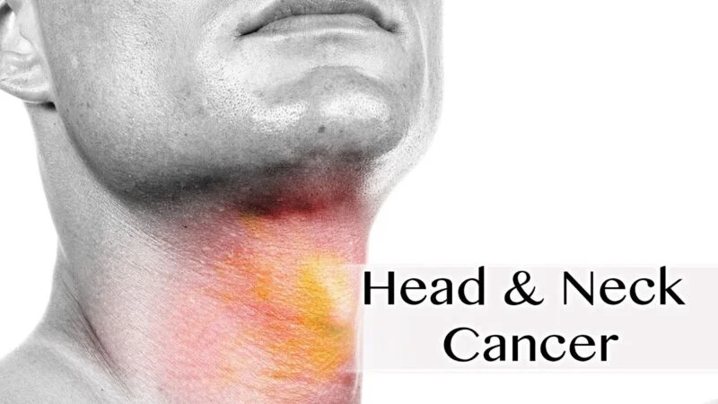Oral bacterial species associated with head and neck squamous cell cancer