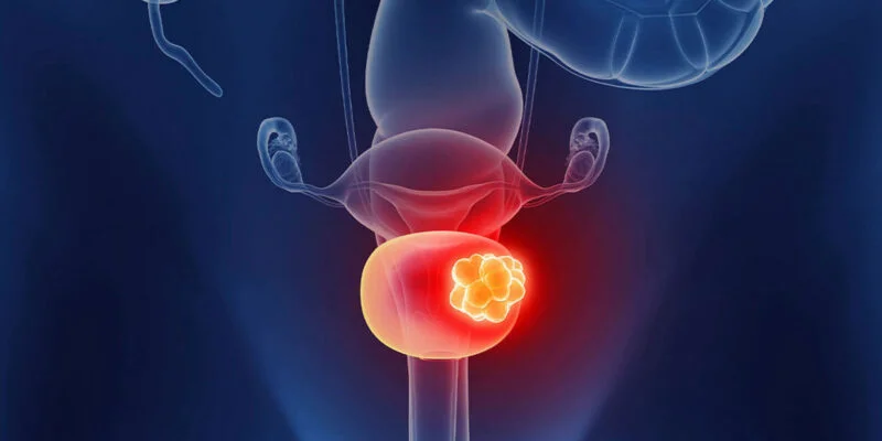 What do you envision for the bladder cancer landscape with the addition of ADCs to the treatment armamentarium?