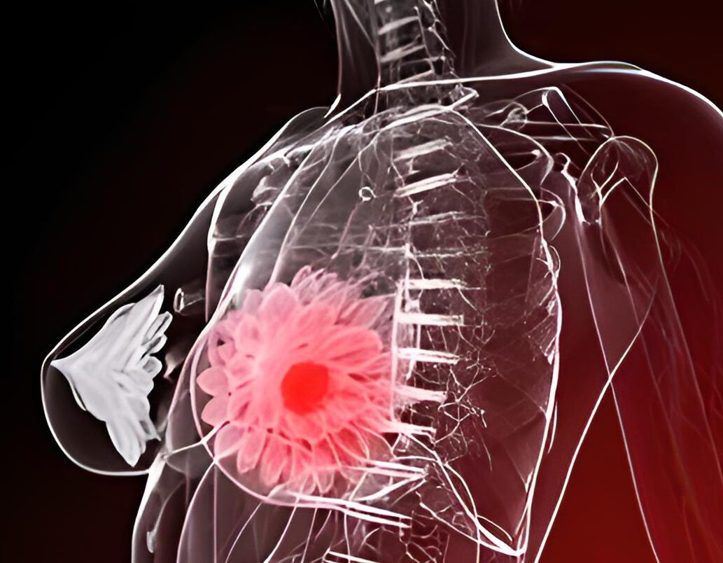 Global study on the accuracy of HER2-low diagnoses among 77 pathologists from 14 countries