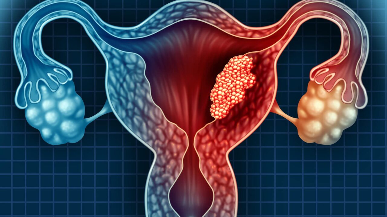 Sacituzumab govitecan (SG) in patients with advanced endometrial cancer