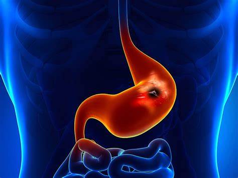 May community eradication of Helicobacter pylori prevent gastric cancer?