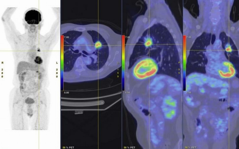 The first case of Lung Cancer detected by AI in Malaysia