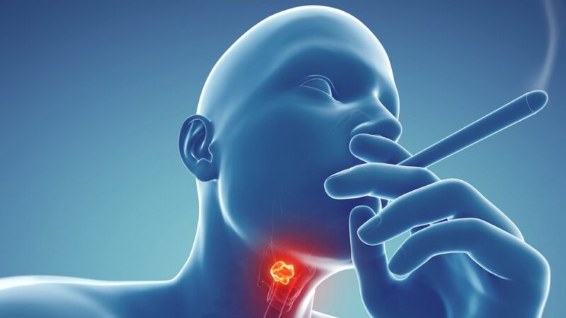 Throat Cancer 