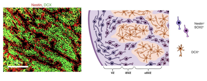 Mariella Filbin: Our latest paper on pediatric/AYA glioma