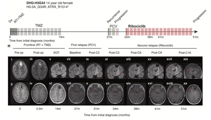 Mariella Filbin: Our latest paper on pediatric/AYA glioma