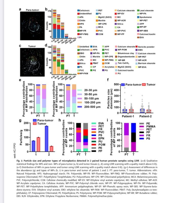 Erman Akkus: Microplastics in prostate tumor and para-tumor