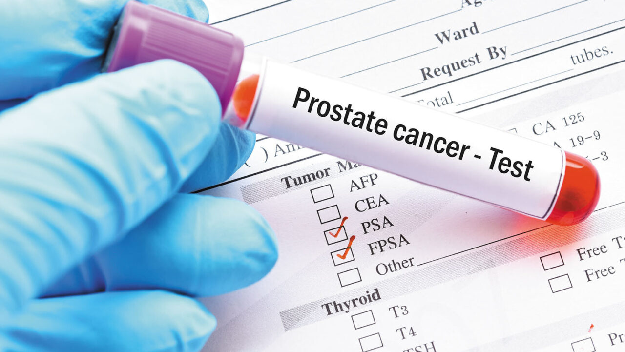 How Can Guidelines Give Clearer Guidance on Prostate Cancer Screening? – Advanced Prostate Cancer Consensus Conference