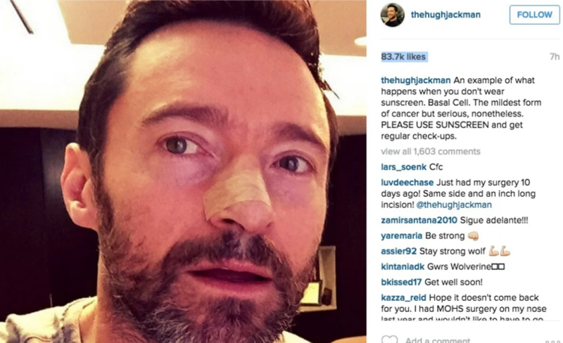 Hugh Jackman Skin Cancer