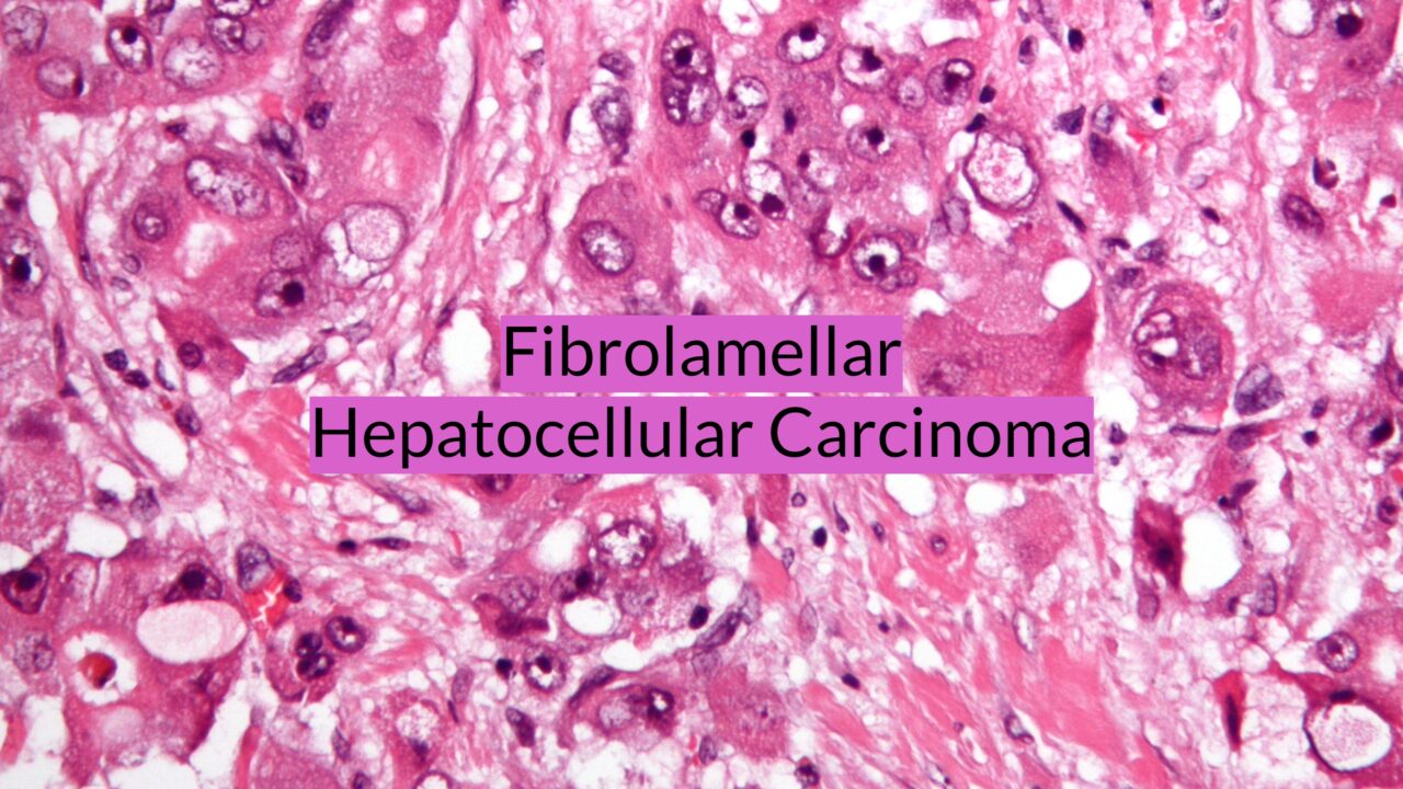 New work on how DNAJB1-PRKACA fusion drives Fibrolamellar Carcinoma