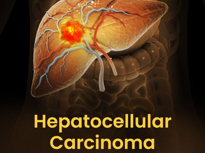 Durable Responses to Atezolizumab Plus Bevacizumab in HCC