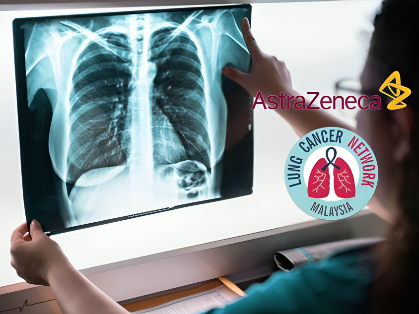 The first case of Lung Cancer detected by AI in Malaysia