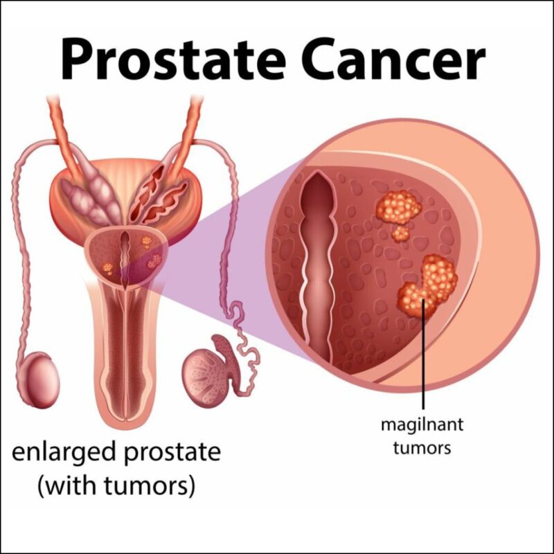 Prostate Cancer