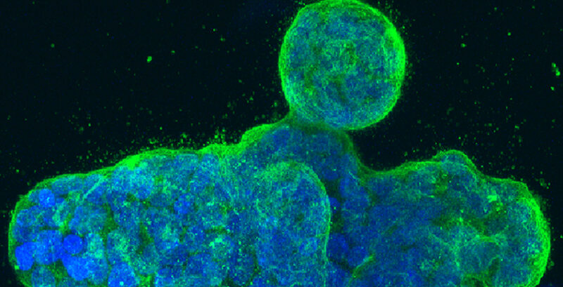 How tumors modify their own gene activity to evade immune detection - Cancer Research Institute