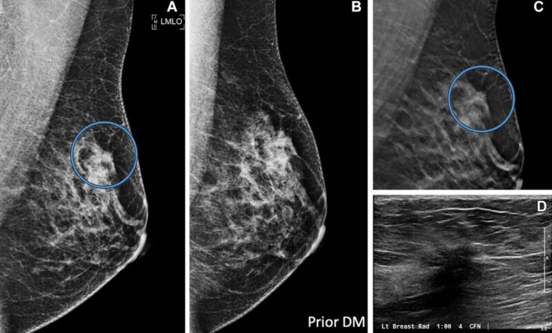 Francisco Esteva: Digital breast tomosynthesis, more effective in breast cancer screening than traditional digital mammography