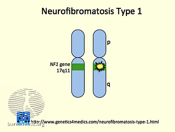 A noninvasive method for assessing PNST tumor risk in patients with NF1