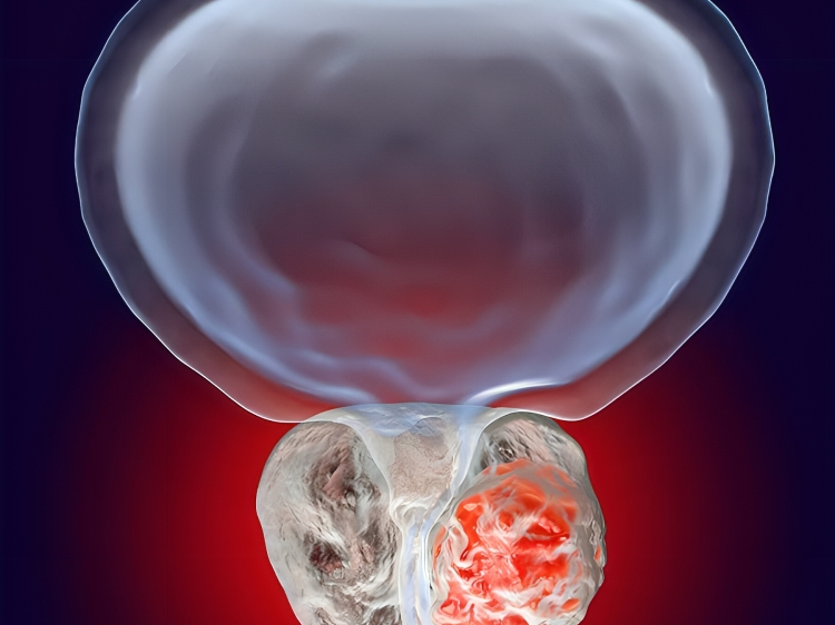 Combining PSMA-PET and PROMISE to re-define disease stage and risk in prostate cancer – APCCC