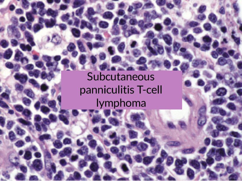 Aaron Goodman: Very rare case of subcutaneous panniculitis T-cell lymphoma