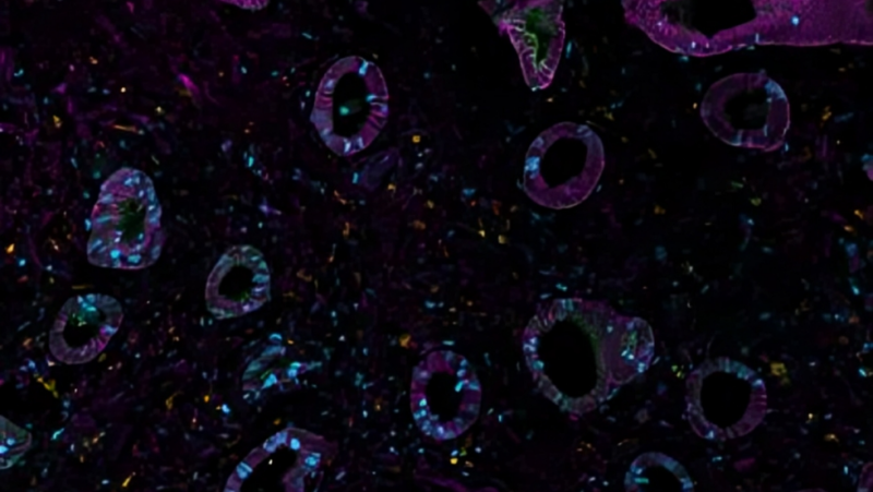 Discovering spatial biology in endometriosis research – European Association for Cancer Research