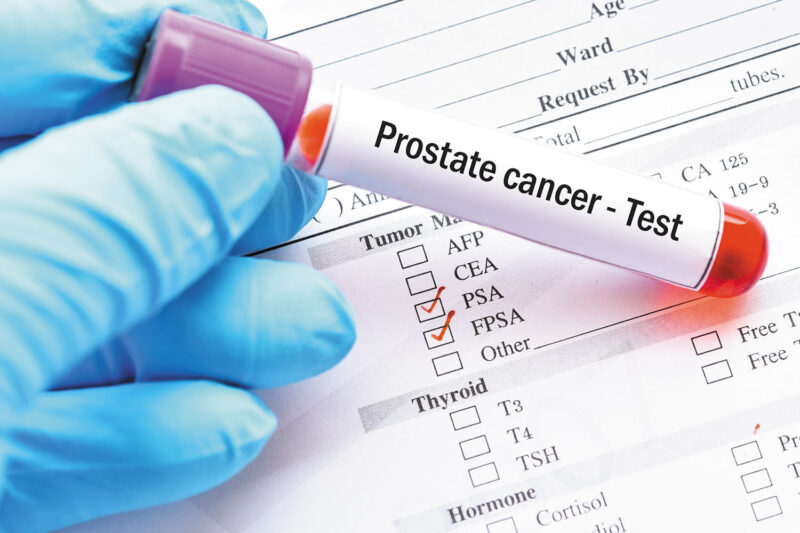 Prostate Cancer