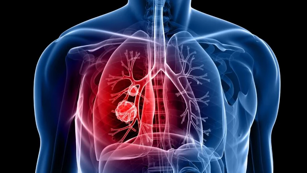 Julian Downward: Mechanisms limiting responses of KRAS mutant lung cancer to KRAS inhibitors and immunotherapy