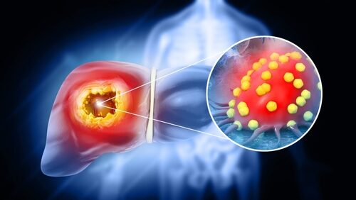 Outcomes in patients with oligoprogression following 1st line IO or ChemoIO