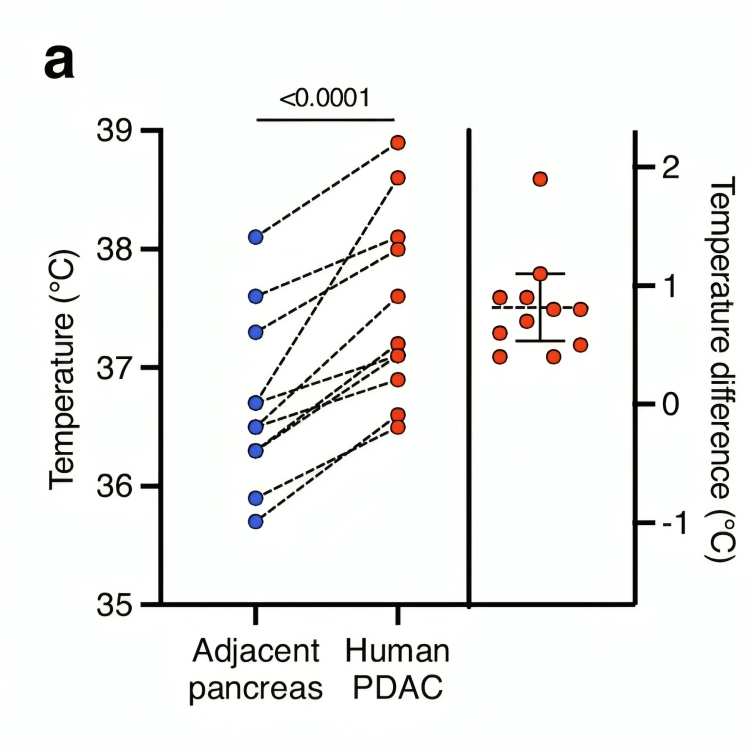 Intrinsic temperature increases ferroptosis evasion and chemotherapy resistance in Pancreatic Cancer, suggested by Anirban Maitra