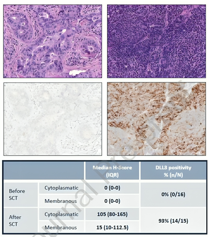 Retrospective report on EGFR mutant NSCLC transformed to SCLC, suggested by Stephen V Liu