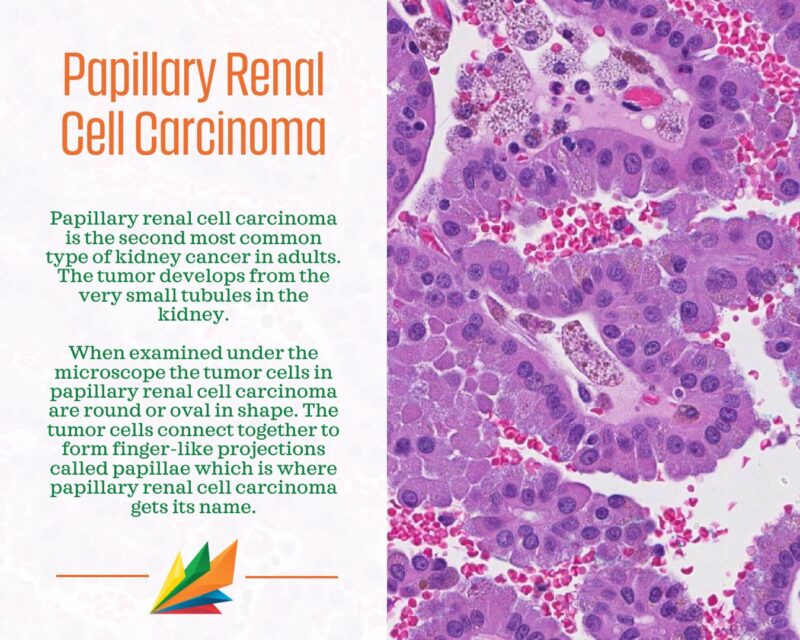 Understanding different types of Kidney Cancer and approaches to treatment - KidneyCAN