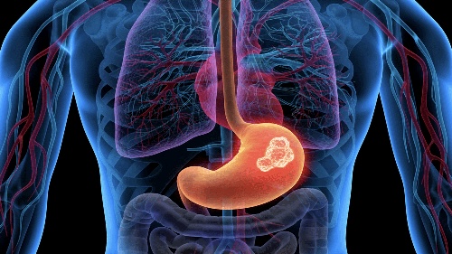 SOX with or without perioperative camrelizumab in locally advanced gastric cancer