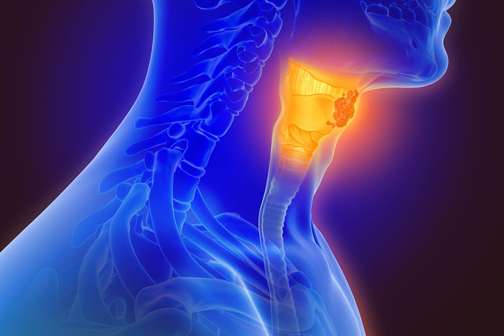 Once-a-Week Versus Once-Every-3-Weeks Cisplatin Along With Radiation in Head and Neck Cancer